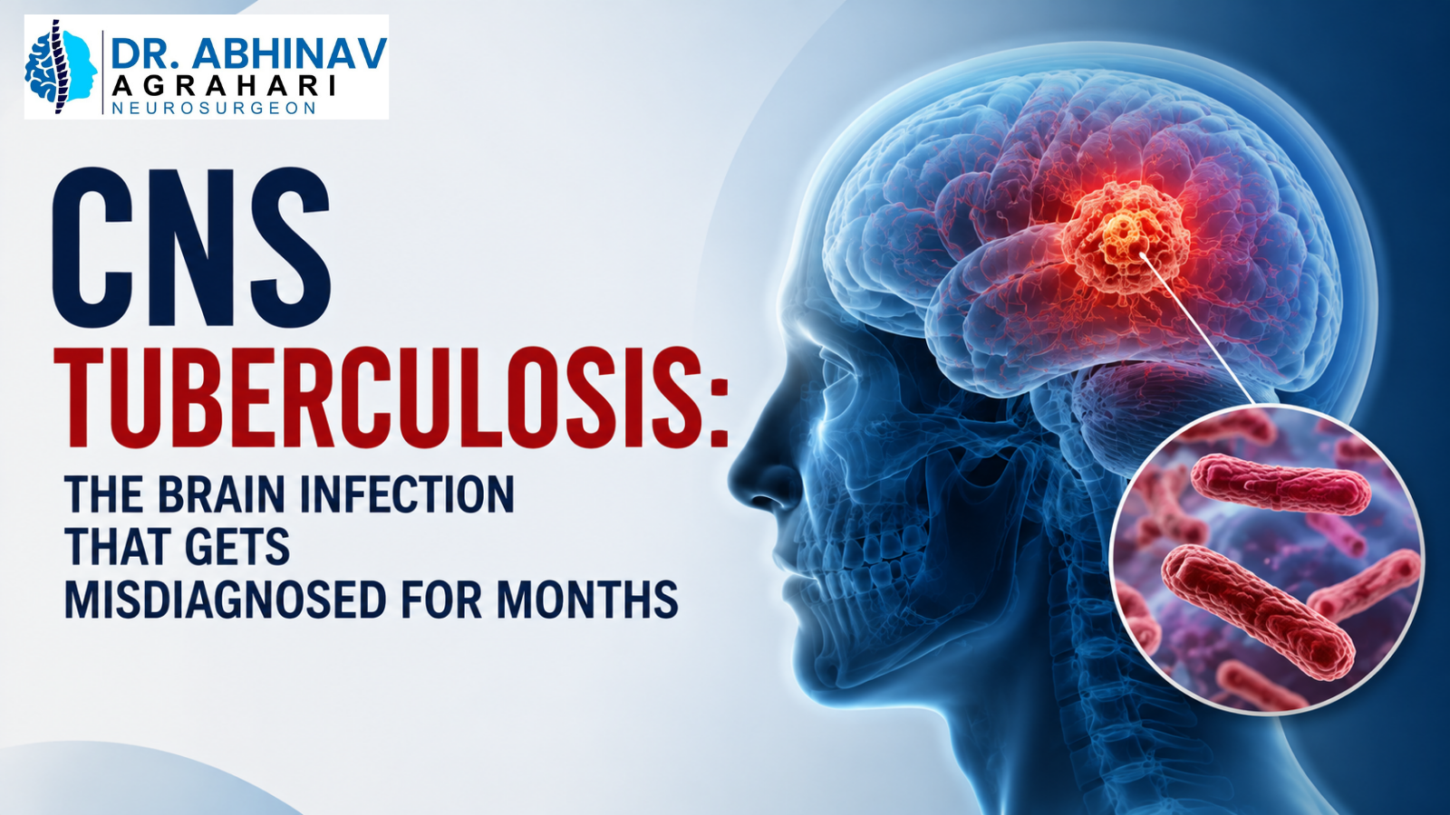 CNS Tuberculosis: The Brain Infection That Gets Misdiagnosed for Months